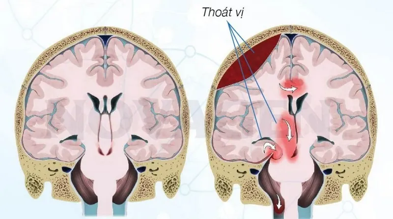 Thoát vị não, tình trạng mô - dịch não tủy, máu bị đẩy khỏi vị trí trong hộp sọ