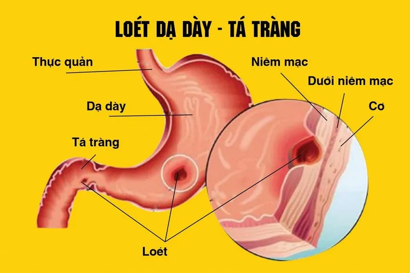 Loét dạ dày tá tràng là bệnh lý về tiêu hóa phổ biến