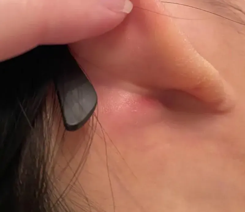 Hạch nổi to, sờ thấy cục là dấu hiệu nhận biết rõ nhất