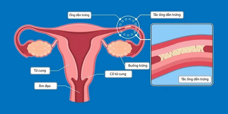 Vòi trứng bị tắc là tình trạng đường ống dẫn trứng bị thu hẹp, dính gây tắc