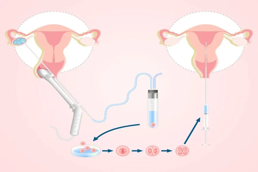 Hình ảnh mô tả quá trình chọc trứng, tạo phôi, nuôi phôi và chuyển phôi vào buồng tử cung