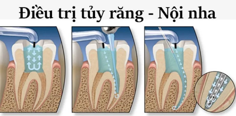 Nếu viêm tủy không hồi phục, có thể phẫu thuật cắt tủy để cứu răng