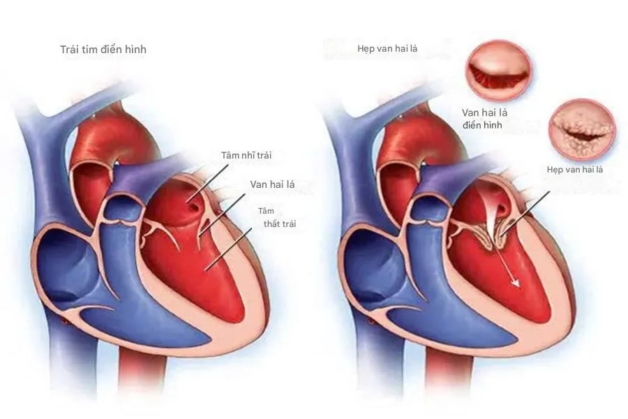 Hẹp van 2 lá là bất thường nguy hiểm có thể đe dọa đến sự sống của thai nhi