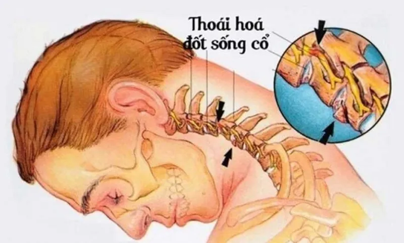 Thoái hóa đốt sống cổ là tình trạng hao mòn sụn và xương ảnh hưởng đến khớp và đĩa đệm cổ