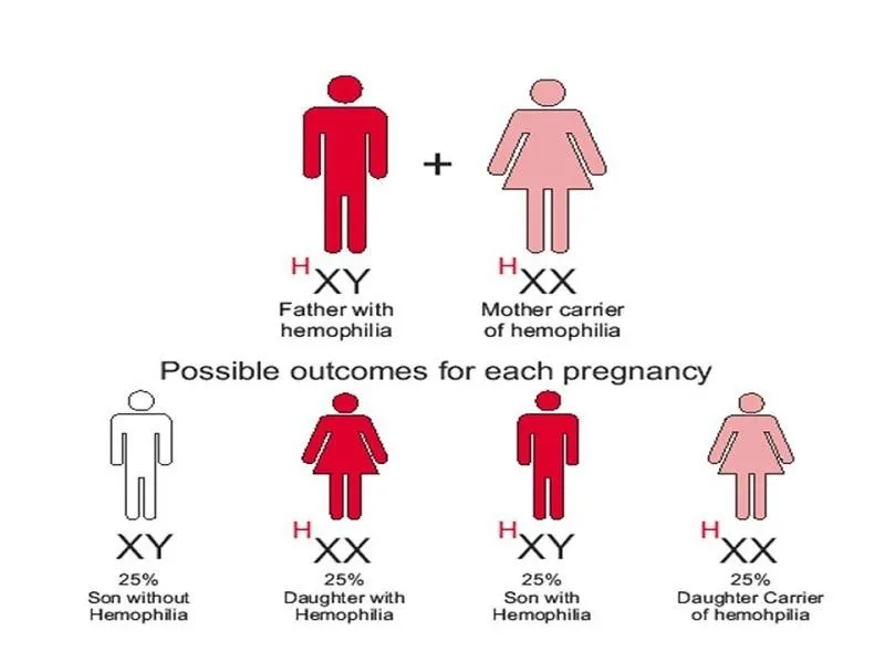 Yếu tố di truyền là nguyên nhân hàng đầu của bệnh Hemophilia