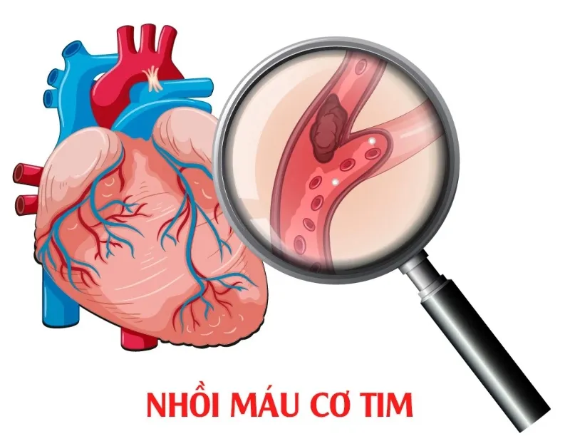 Nhồi máu cơ tim dẫn đến tình trạng thiếu máu cơ tim đột ngột