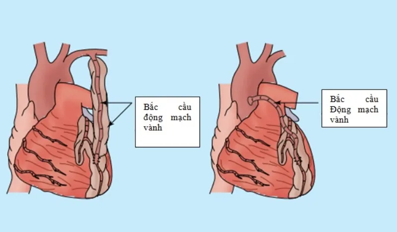 Phẫu thuật bắc cầu động mạch vành là một phương pháp điều trị nhồi máu cơ tim phổ biến