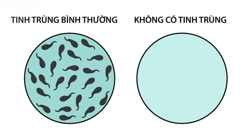 Không có tinh trùng là tình trạng tinh dịch không có tinh trùng nào