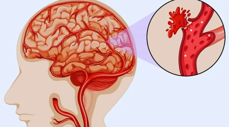 Rối loạn đông máu là tình trạng mà cơ thể không thể kiểm soát quá trình đông máu