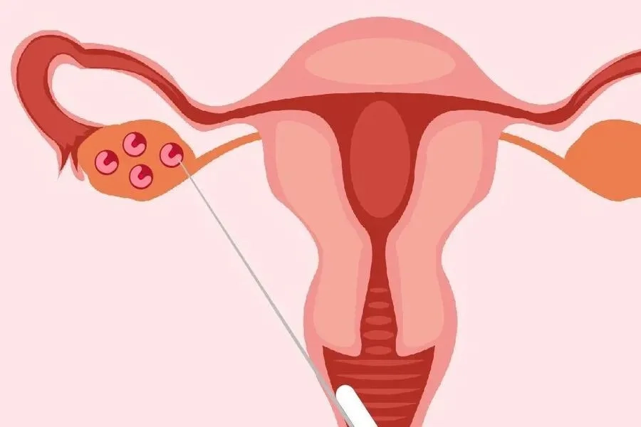 Tiêm thuốc IVF-C 5000 IU kích thích rụng trứng để thực hiện IVF, IUI hoặc thụ thai tự nhiên
