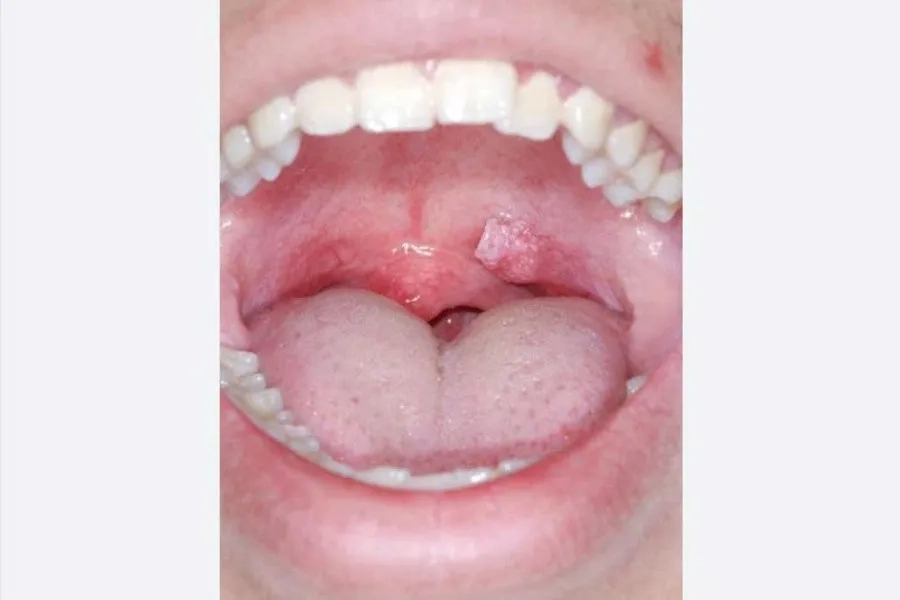 Virus HPV có thể gây mụn cóc sinh dục xuất hiện ở vùng hầu họng