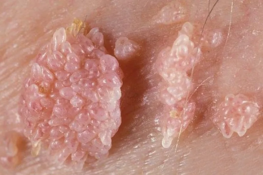 Mụn cóc sinh dục (sùi mào gà) có thể xuất hiện ở miệng, cơ quan sinh dục