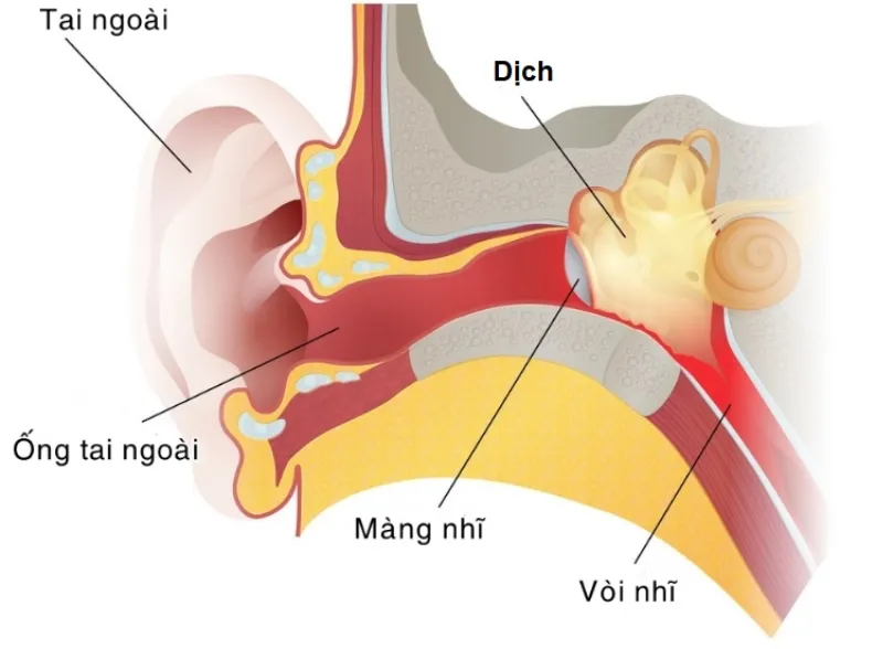 Viêm tai giữa ứ dịch là tình trạng tích tụ dịch không bị nhiễm trùng ở khoang tai giữa