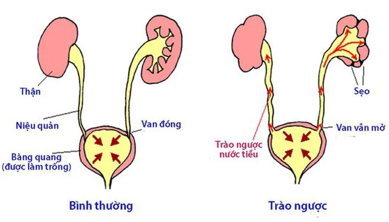 Trào ngược bàng quang niệu quản (VUR) là tình trạng nước tiểu từ bàng quang chảy ngược lên niệu quản và có thể đến thận