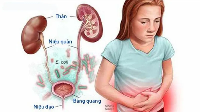 Trẻ càng nhỏ tuổi thì nguy cơ mắc trào ngược bàng quang niệu quản (VUR) càng cao