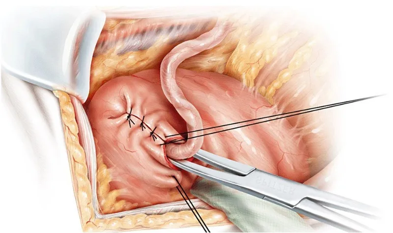 Trẻ em bị trào ngược bàng quang niệu quản (VUR) độ 4 và 5 có thể cần phẫu thuật