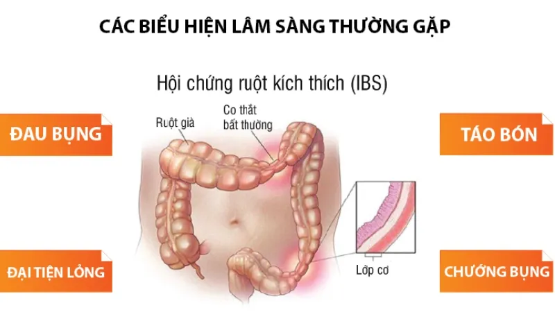 Các triệu chứng của hội chứng ruột kích thích có thể xuất hiện thường xuyên hoặc theo từng đợt