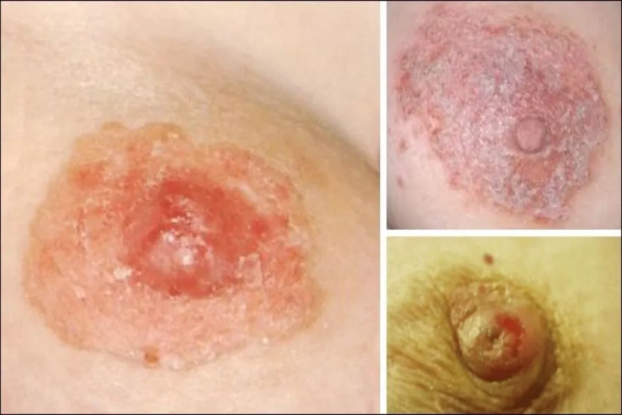 Da vùng ngực xuất hiện sần sùi hoặc lõm có thể là dấu hiệu cảnh báo bệnh lý nguy hiểm