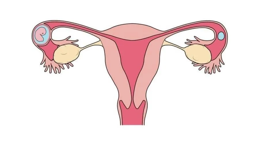 Ống dẫn trứng bị tổn thương là nguyên nhân dẫn đến chửa ngoài tử cung