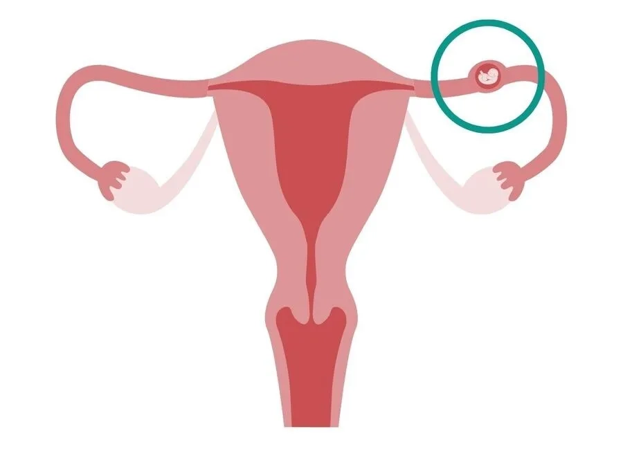 Thai ngoài tử cung thường xảy ra ở ống dẫn trứng