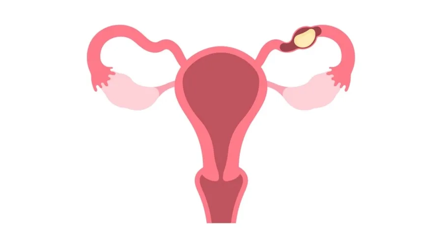 Tổn thương ống dẫn trứng là nguyên nhân gây chửa ngoài tử cung điển hình