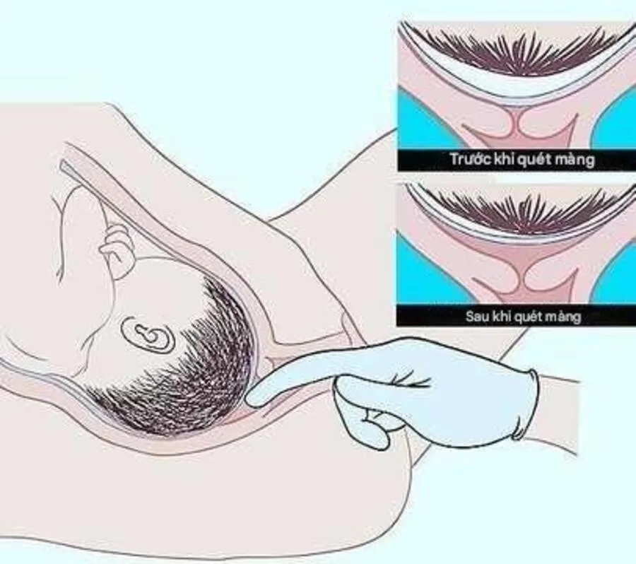 Lách ối là thủ thuật sản khoa giúp kích thích cổ tử cung co bóp và thúc đẩy quá trình sinh nở