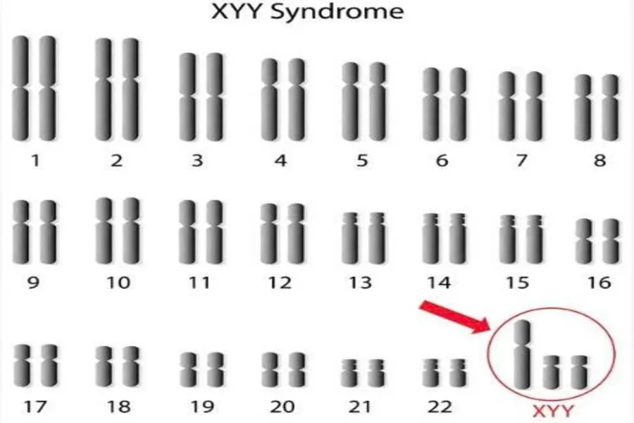 Bảng nhiễm sắc thể (karyotype) của nam giới mắc Hội chứng Jacobs (XYY): 47 NST thay vì 46 bình thường