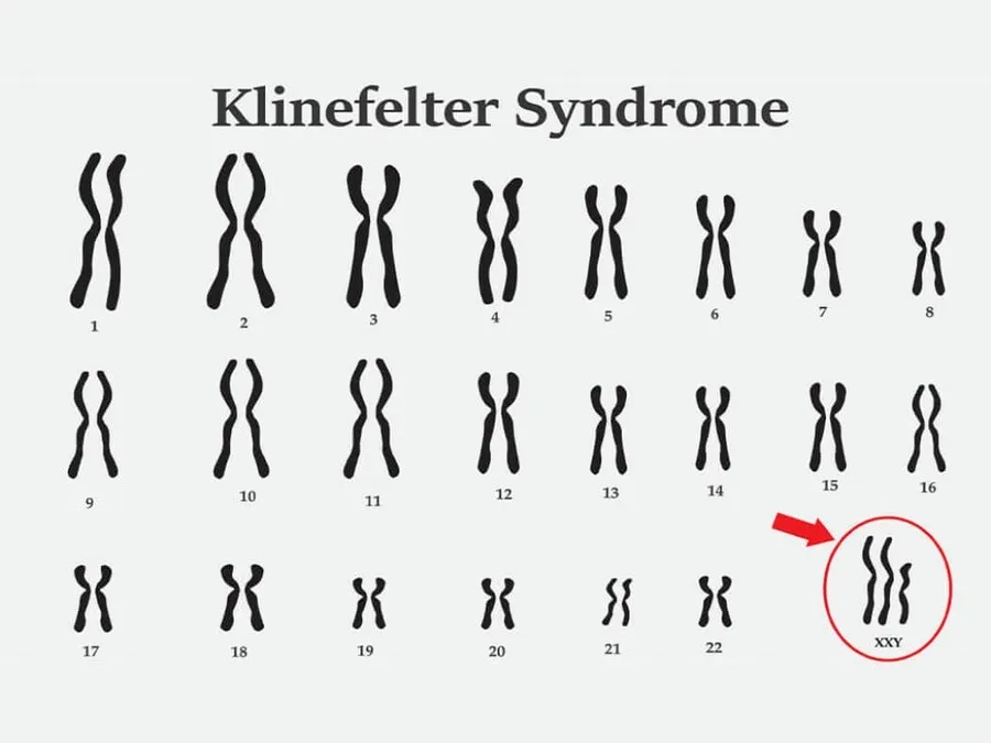 Hội chứng Klinefelter xảy ra ở nam giới do xuất hiện thêm 1 NST X tạo nên 47,XXY