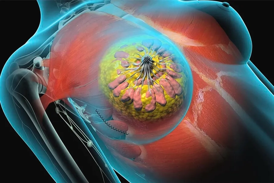 Phẫu thuật ung thư vú là bước quan trọng trong hành trình điều trị và hồi phục