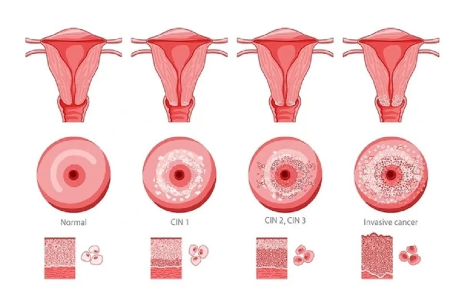 Hình ảnh mô phỏng sự hình thành và tiến triển của tiền ung thư cổ tử cung