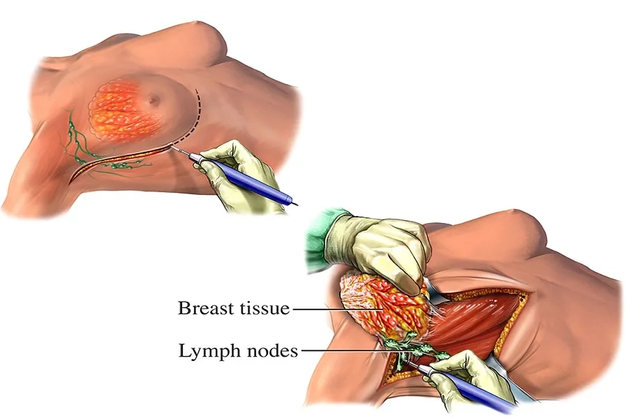 Bác sĩ xác định đối tượng cần mổ ung thư vú dựa trên giai đoạn và tình trạng sức khỏe
