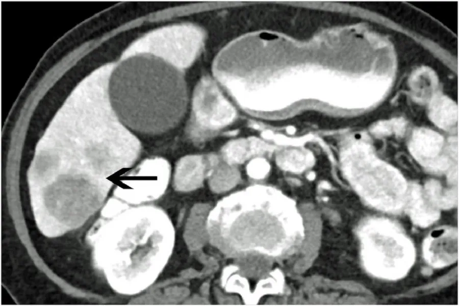 Khi bệnh đã di căn, tiên lượng sống của ung thư cổ tử cũng thay đổi đáng kể