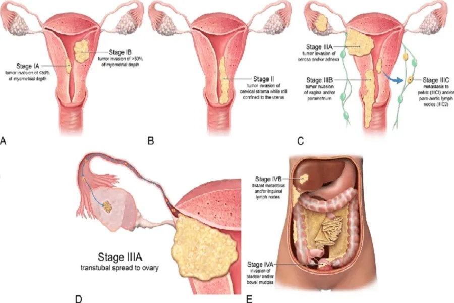 Sự tiến triển của ung thư nội mạc tử cung qua từng giai đoạn