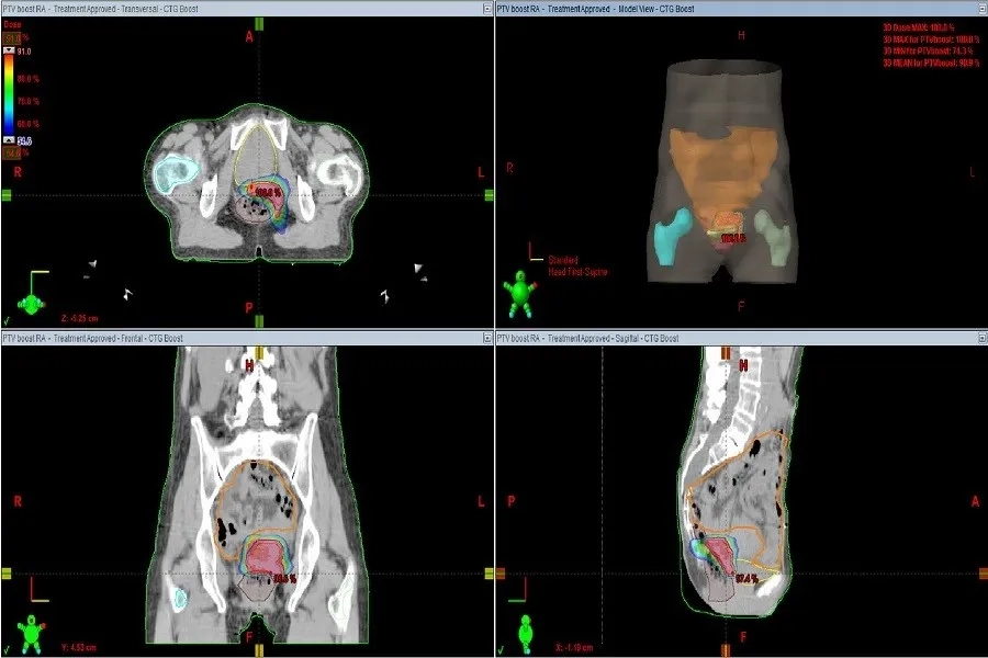 Xạ trị ung thư cổ tử cung giúp thu nhỏ và tiêu diệt khối u, ngăn chặn tế bào ác tính phát triển