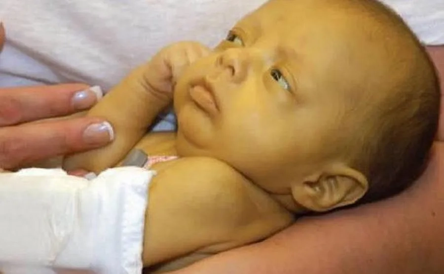 Bất đồng nhóm máu mẹ con có thể gây vàng da sơ sinh nặng