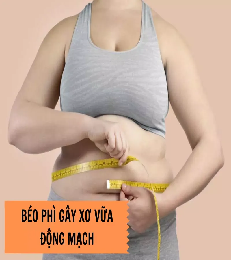 Động mạch xơ vữa có thể dễ gặp ở người bị thừa cân, béo phì