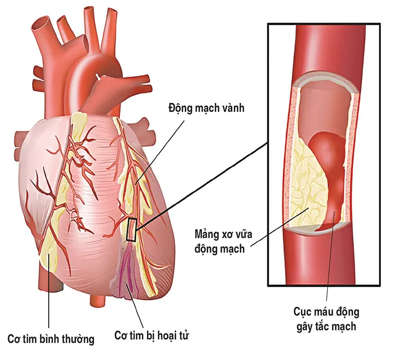 Xơ vữa động mạch xảy ra khi động mạch tắc nghẽn do có sự tích tụ các mảng vữa hay bị xơ cứng 