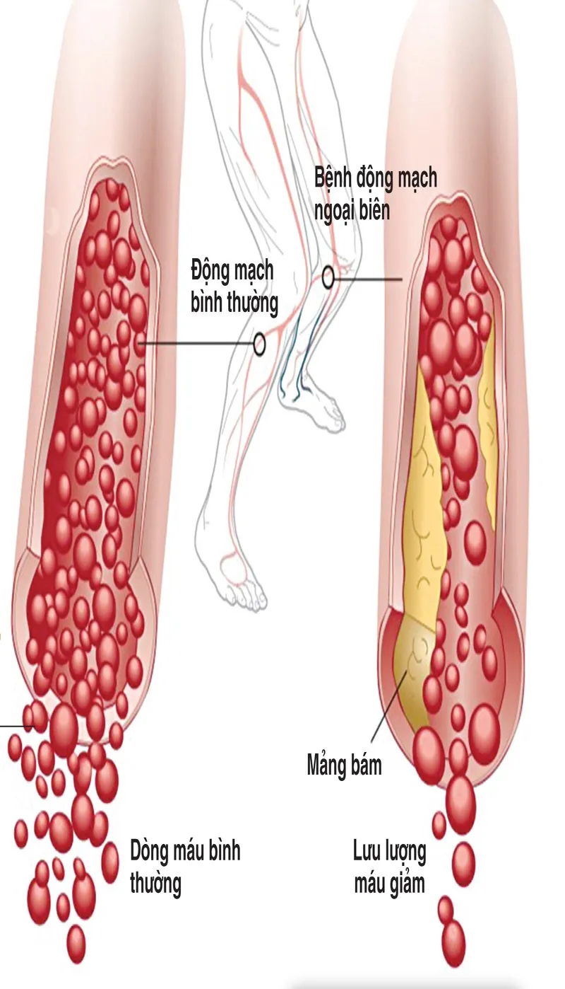 Mảng xơ vữa làm hẹp các động mạch chính cung cấp máu cho chân