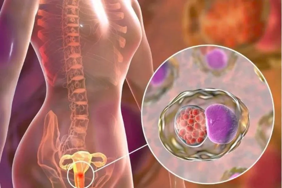 HPV 16,18 là nguyên nhân hàng đầu dẫn đến ung thư cổ tử cung