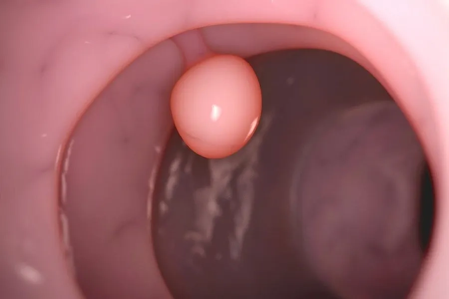 Polyp cổ tử cung có nguy cơ rất nhỏ tiến triển thành ung thư cổ tử cung