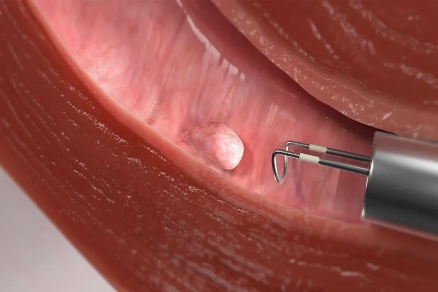 Tùy vào kích thước, vị trí, bác sĩ sẽ lựa chọn phương pháp cắt polyp phù hợp