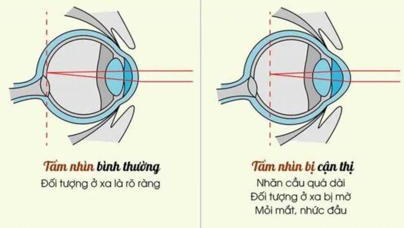 Bệnh cận thị là bệnh lý khi mắt không thể nhìn thấy vật thể ở xa