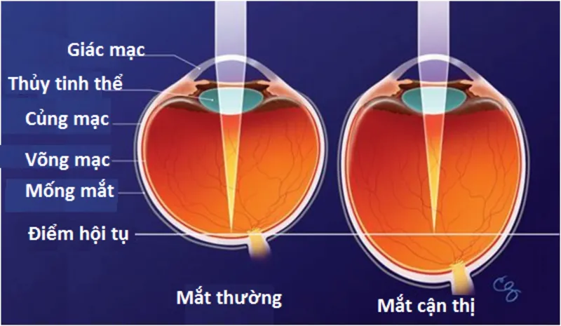 Nhãn mạc mắt quá dài hay quá cong sẽ gây bệnh cận thị