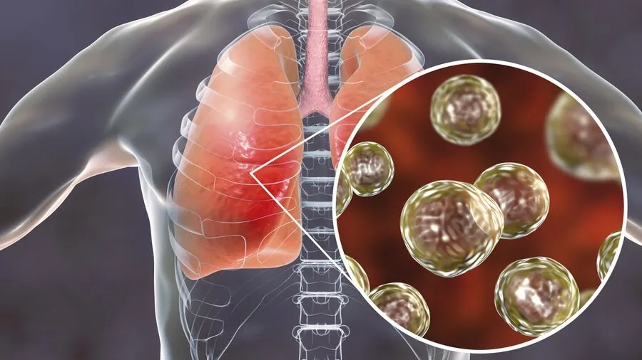 Nấm xâm nhập đường hô hấp có thể gây tổn thương nhu mô phổi
