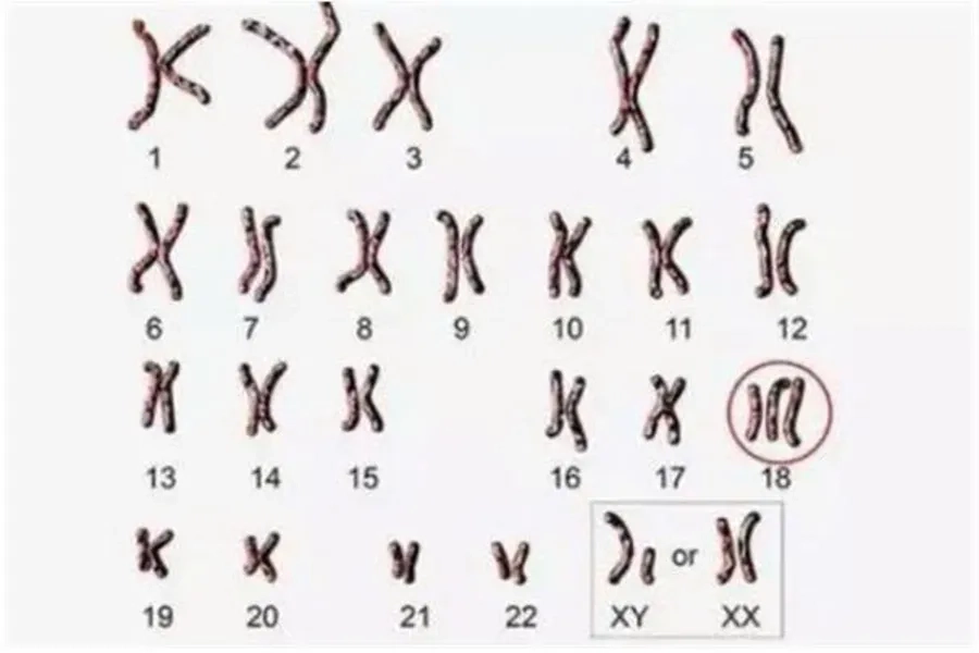 Hội chứng Edwards xảy ra do thừa một nhiễm sắc thể số 18