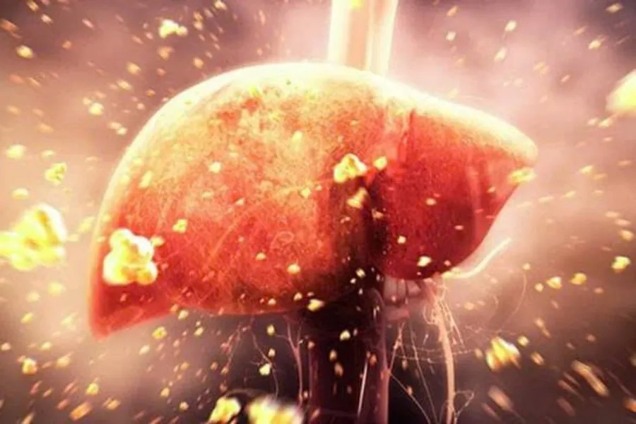 Suy đa tạng là dấu hiệu của sốt xuất huyết cần được can thiệp sớm