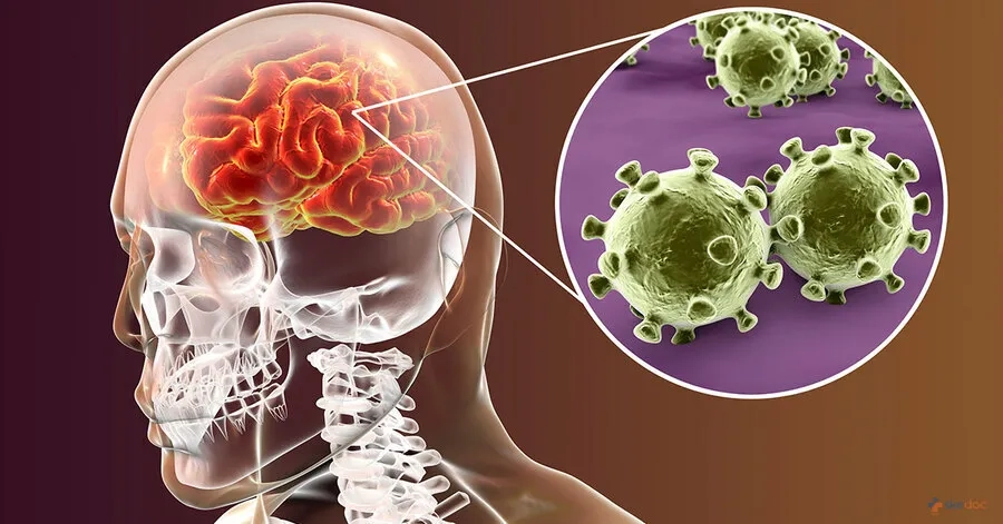 Nhiễm trùng màng não do virus thường nhẹ hơn so với nhiễm trùng màng não do vi khuẩn