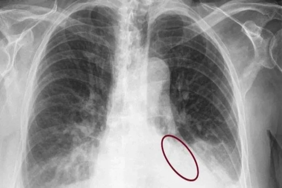 Tràn dịch màng phổi là một trong những biểu hiện nguy hiểm của sốt xuất huyết