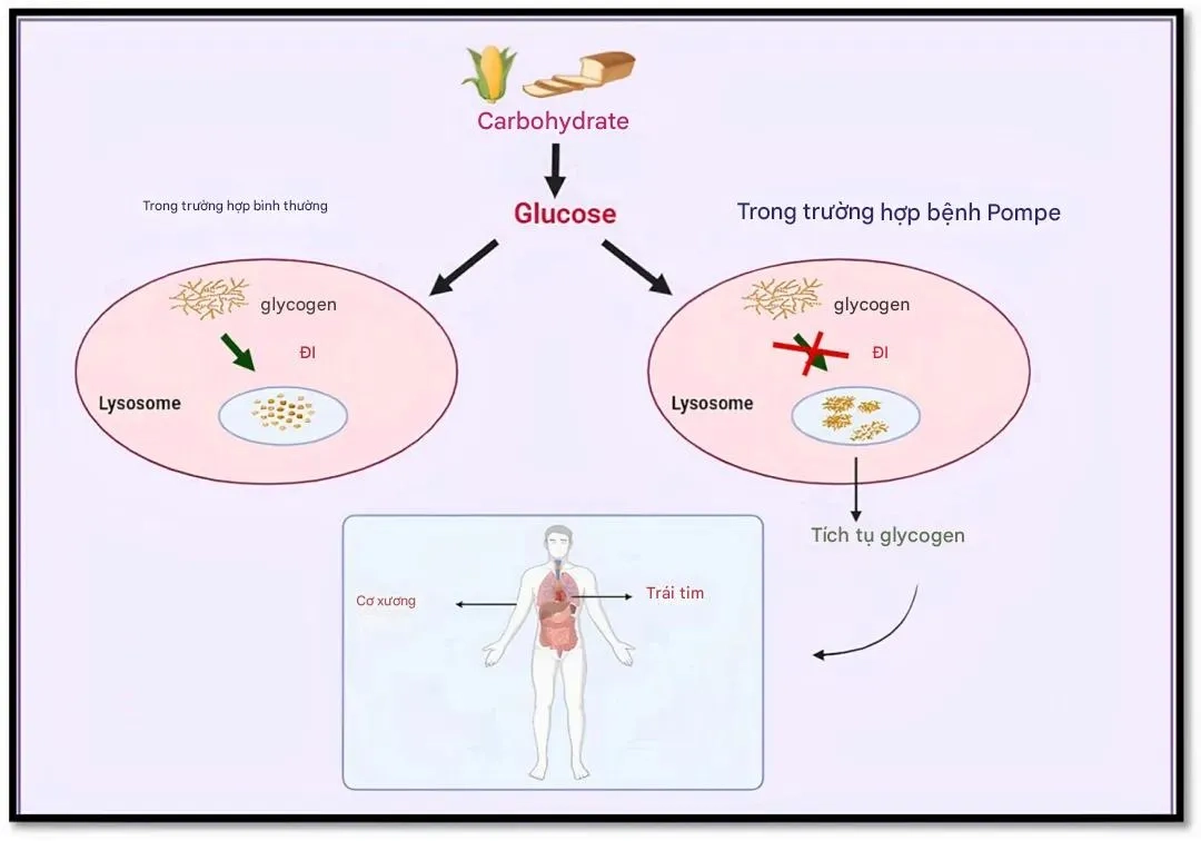 Bệnh Pompe là một rối loạn di truyền hiếm gặp