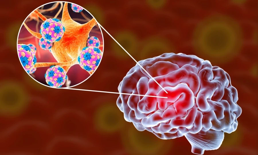 Viêm não mô cầu là bệnh nhiễm khuẩn cấp tính nguy hiểm